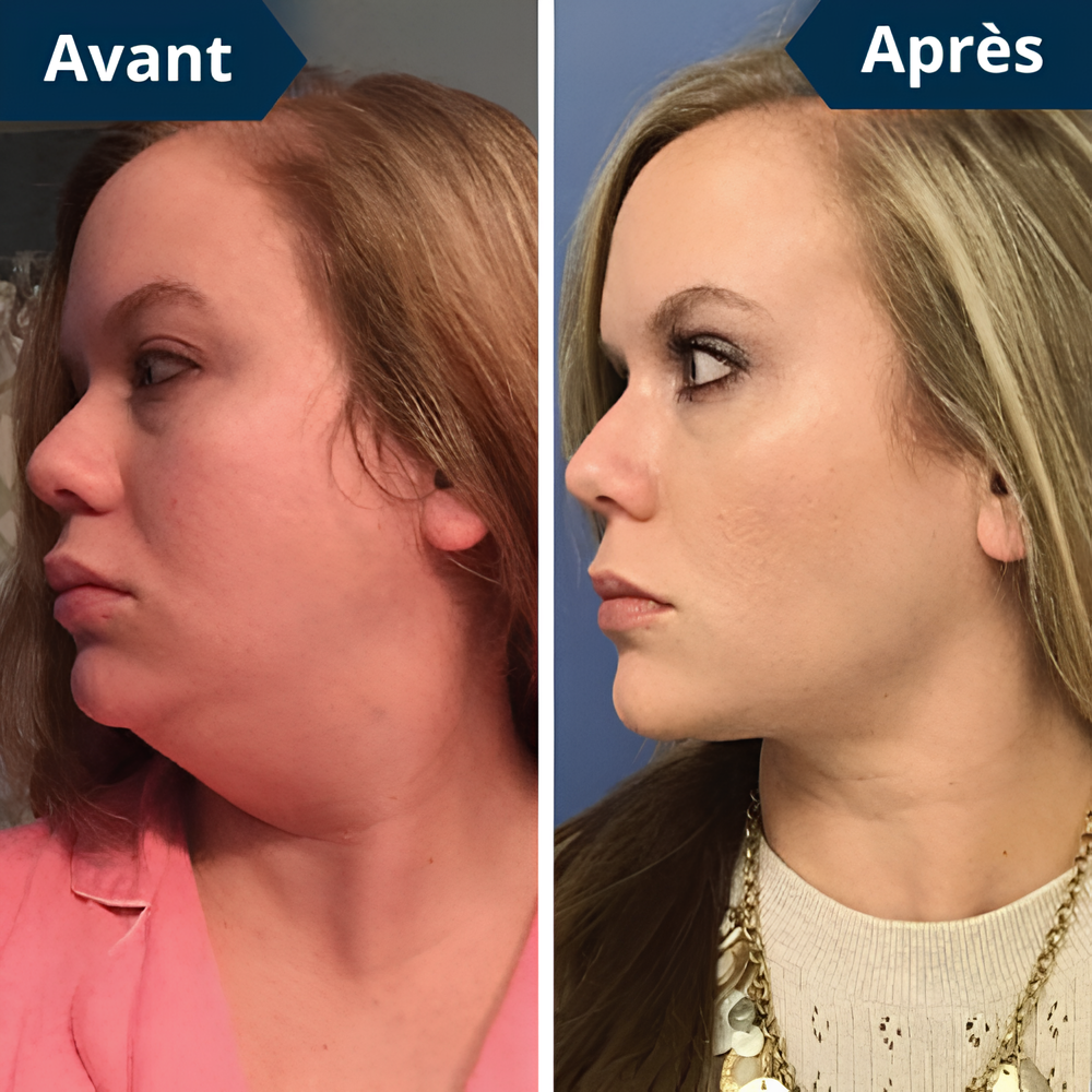 FaceLift™ – Appareil Anti-Rides & Double Menton + Gel Aloe Vera Offert
