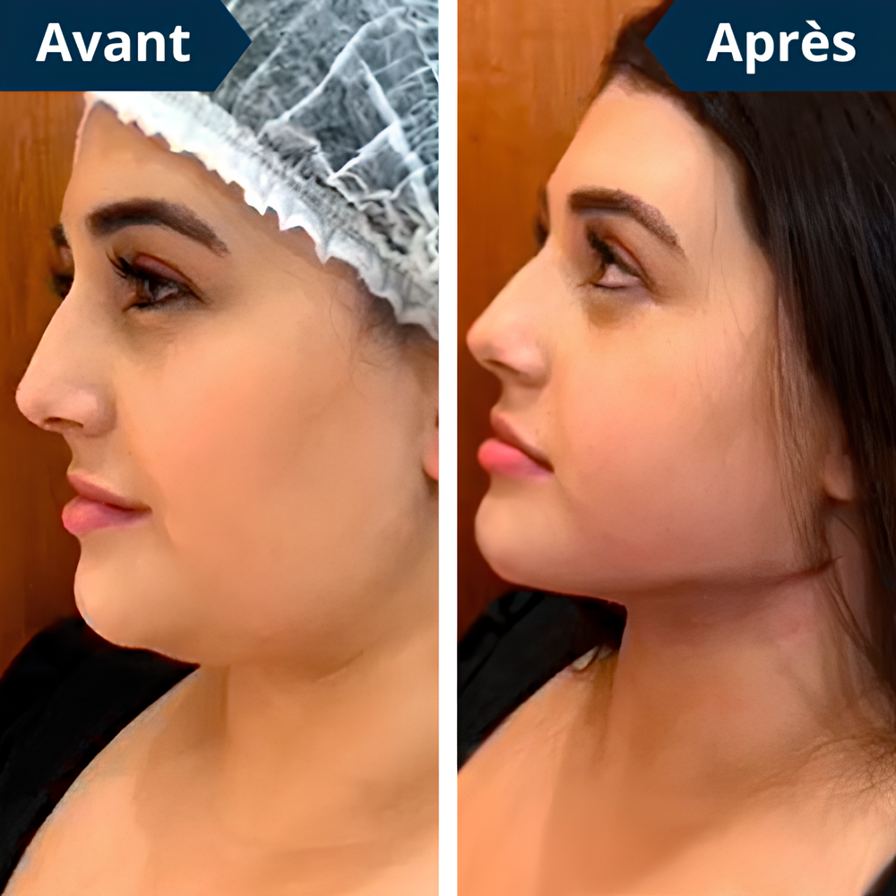 FaceLift™ – Appareil Anti-Rides & Double Menton + Gel Aloe Vera Offert