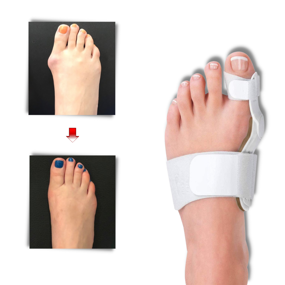 Correcteur orthopédique d'oignon