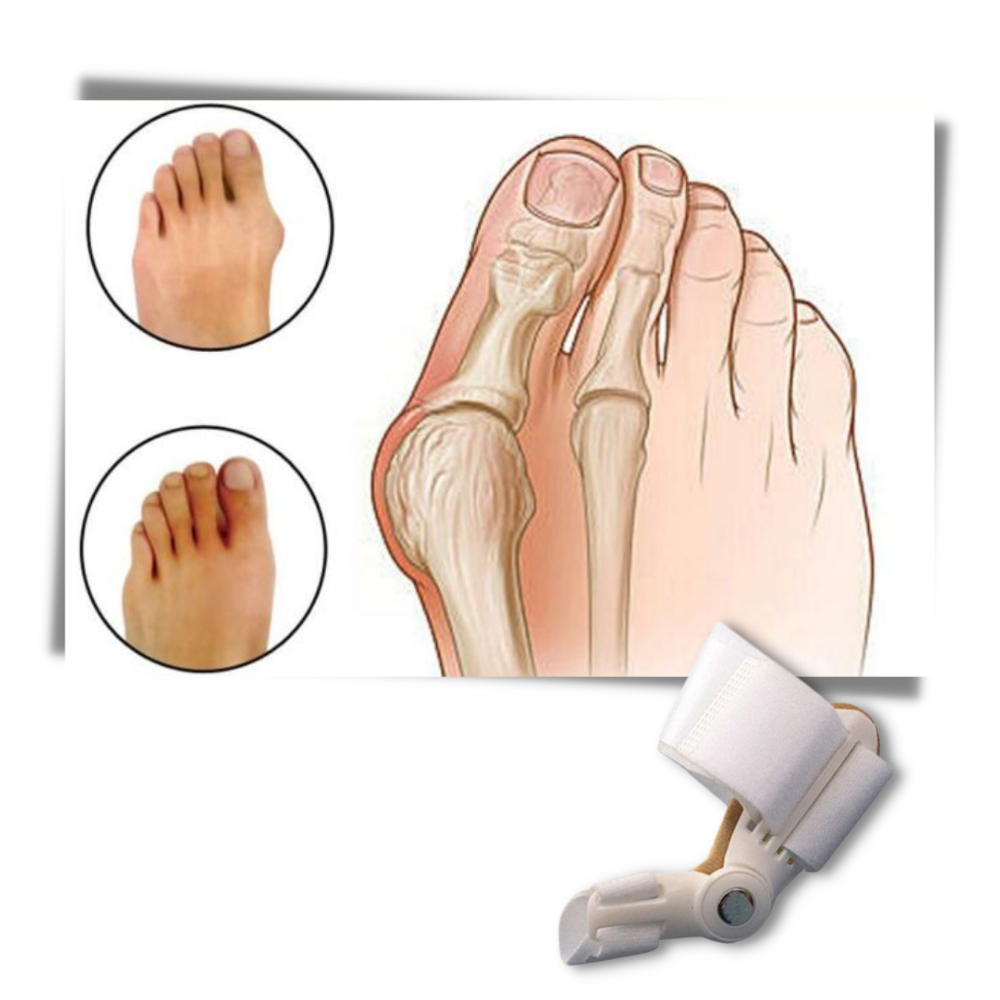 Correcteur orthopédique d'oignon