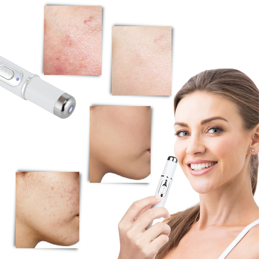 Stylo de thérapie de la peau à la lumière bleue