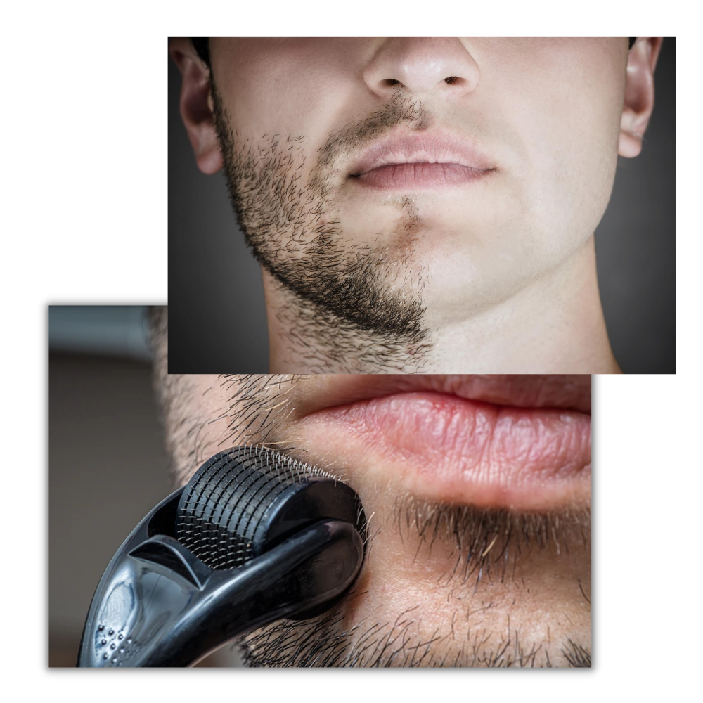 Rouleau dermique pour la croissance des cheveux et de la barbe