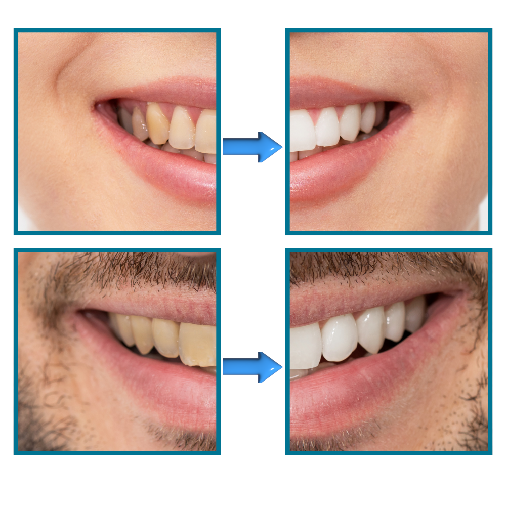 Dentifrice blanchisseur de dents et élimination rapide des taches